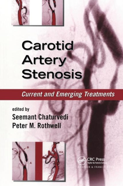 Book cover of: Carotid Artery Stenosis. By: Seemant Chaturvedi