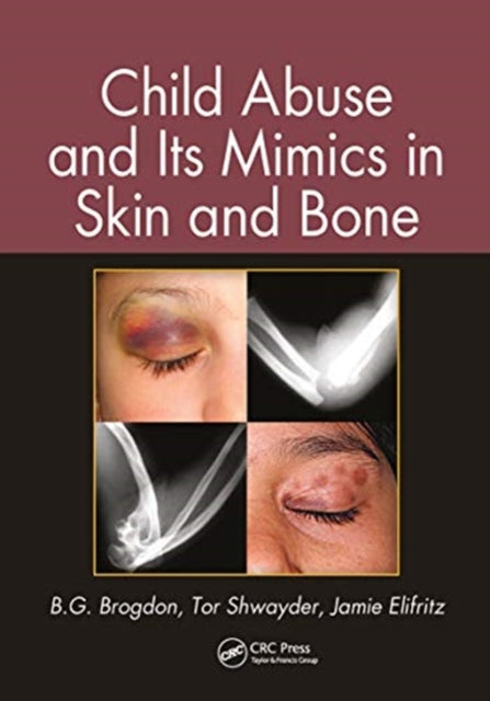 Book cover of: Child Abuse and its Mimics in Skin and Bone. By: B. G. Brogdon