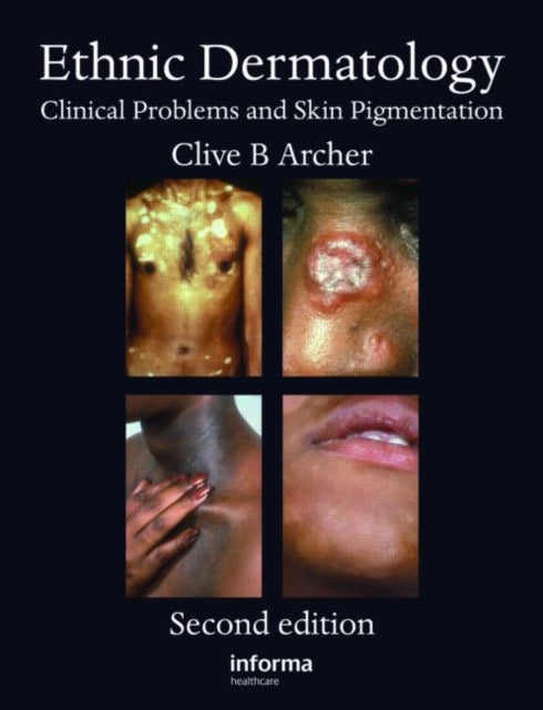 Book cover of: Ethnic Dermatology. By: Clive B. Archer