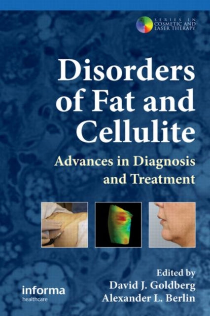 Book cover of: Disorders of Fat and Cellulite. By: Goldberg, David J. M.D.