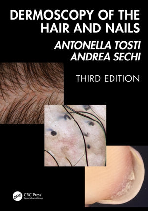 Dermoscopy of the Hair and Nails 3e