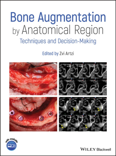 Book cover of: Bone Augmentation by Anatomical Region. By: Zvi Artzi