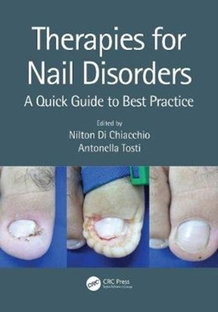 Book cover of: Therapies for Nail Disorders. By: Nilton Di Chiacchio