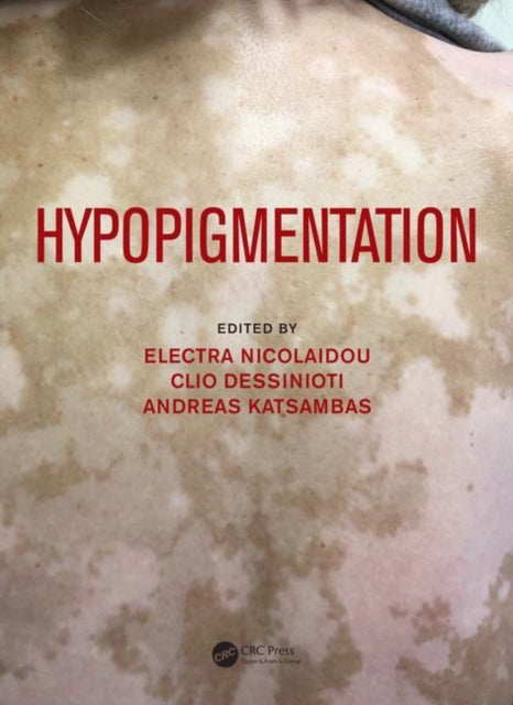 Book cover of: Hypopigmentation. By: Electra Nicolaidou