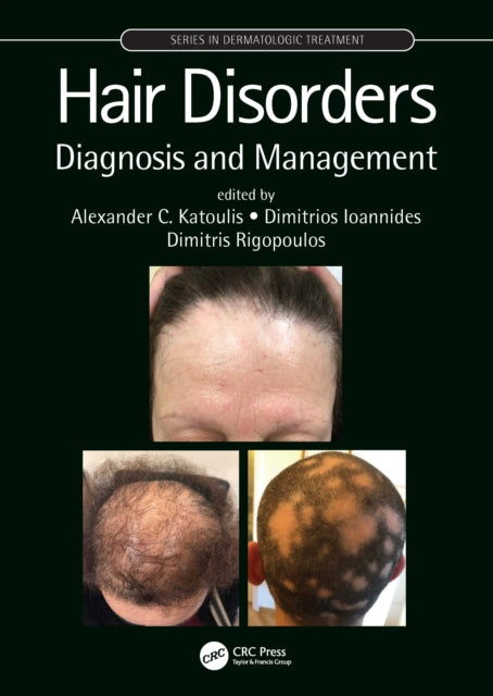 Book cover of: Hair Disorders. By: Alexander C. Katoulis