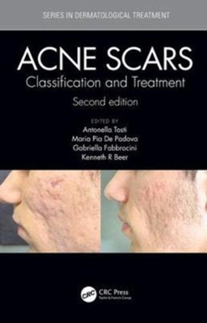Book cover of: Acne Scars. By: Antonell Tosti