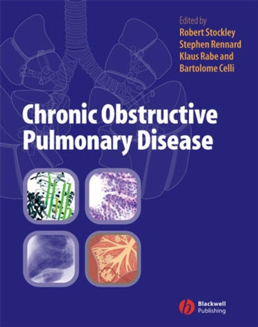 Book cover of: Chronic Obstructive Pulmonary Disease