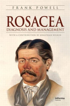 Rosacea