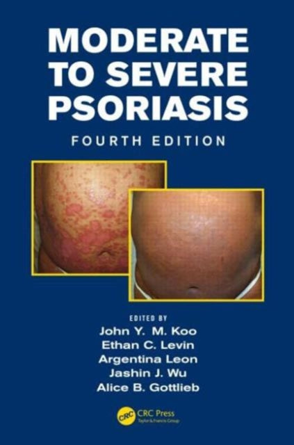 Book cover of: Moderate to Severe Psoriasis. By: John Y. M. Koo