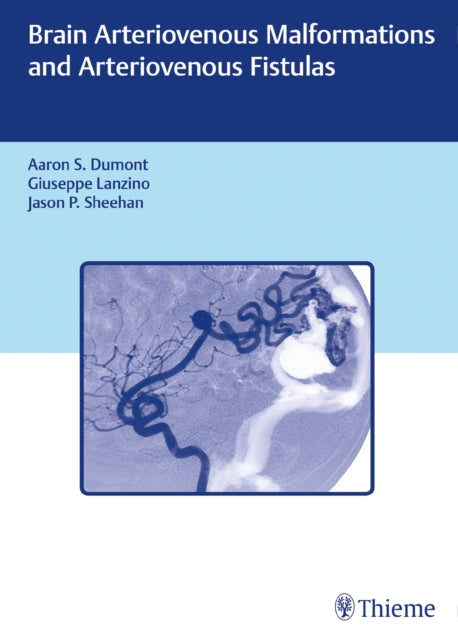 Book cover of: Brain Arteriovenous Malformations and Arteriovenous Fistulas. By: Aaron S. Dumont