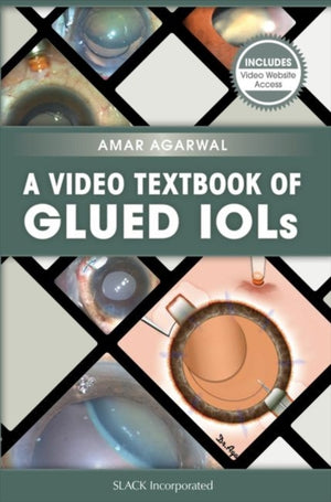 A Video Textbook of Glued IOLs
