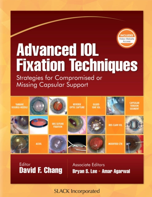 Book cover of: Advanced IOL Fixation Techniques. By: David F. Chang