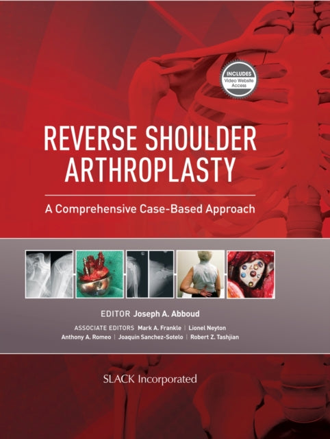 Book cover of: Reverse Shoulder Arthroplasty. By: J. Abboud