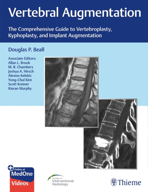 Book cover of: Vertebral Augmentation. By: Douglas Beall