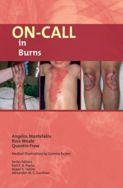 Book cover of: On-Call in Burns. By: Weale MANTELAKIS