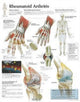 Book cover of: Rheumatoid Arthritis Paper Poster
