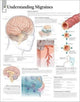 Book cover of: Understanding Migraines Paper Poster