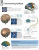 Book cover of: Understanding Epilepsy Laminated Poster. By: Scientific Publishing
