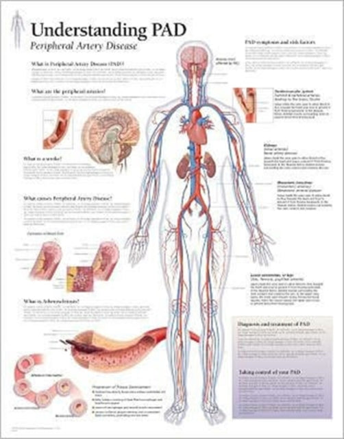 Book cover of: Understanding PAD Laminated Poster. By: Scientific Publishing