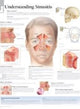 Book cover of: Understanding Sinusitis Laminated Poster