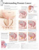 Book cover of: Understanding Prostate Cancer Paper Poster