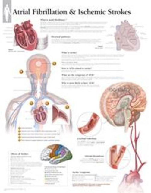 Book cover of: Atrial Fib & Ischemic Strokes Paper Poster