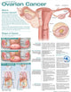 Book cover of: Understanding Ovarian Cancer Anatomical Chart