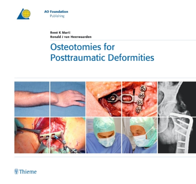 Book cover of: Osteotomies for Posttraumatic Deformities