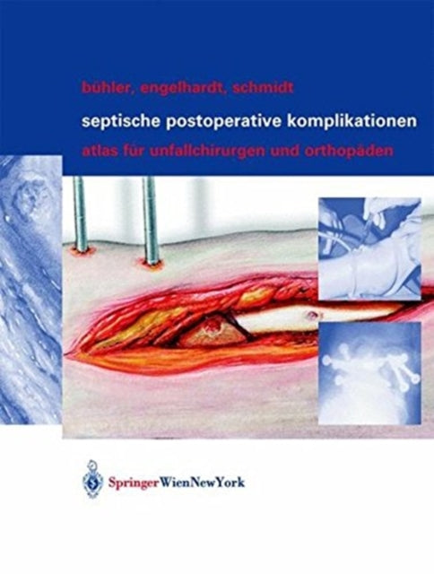 Book cover of: Septische postoperative Komplikationen. By: Matthias Bühler