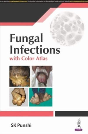 Fungal Infections